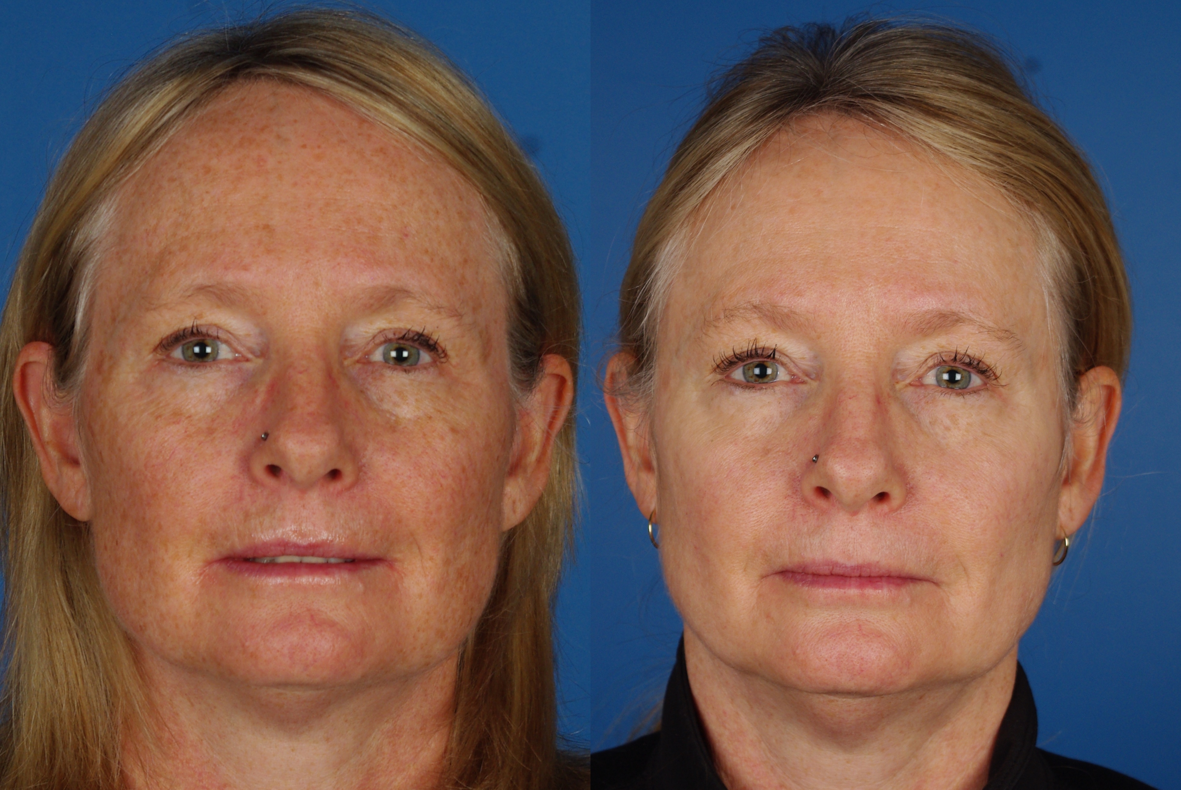 Denver Laser Wrinkle Treatments Raval Facial Aesthetics